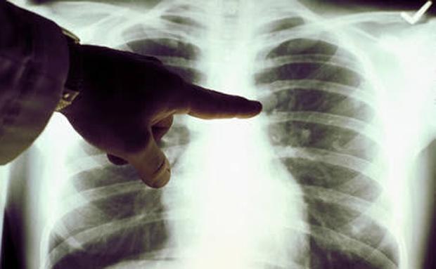 Radiografía de un cáncer de pulmón:: HOY/