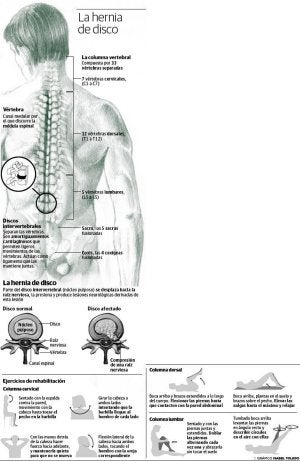 Hernia discal, lo último es operar