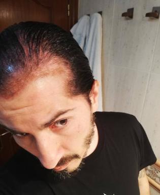 Un hombre denuncia que un tinte le ha quemado parte del cuero cabelludo