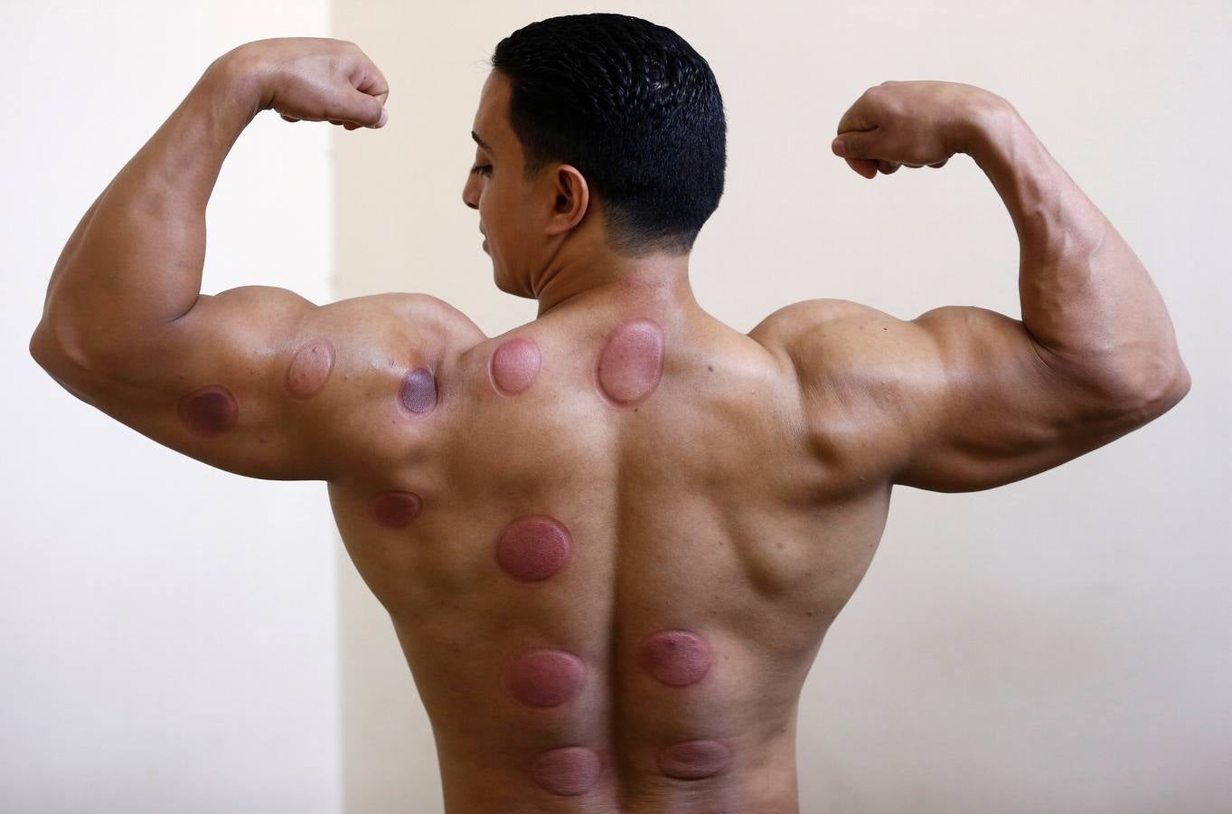 La terapia de ahuecamiento Hijama