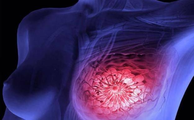 857 mujeres empiezan hoy a hacerse mamografías de prevención