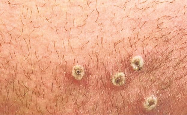 Qué es el 'chemsex' y qué relación tiene con la viruela del mono