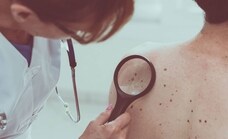 Cáncer de piel: estos son los síntomas del melanoma