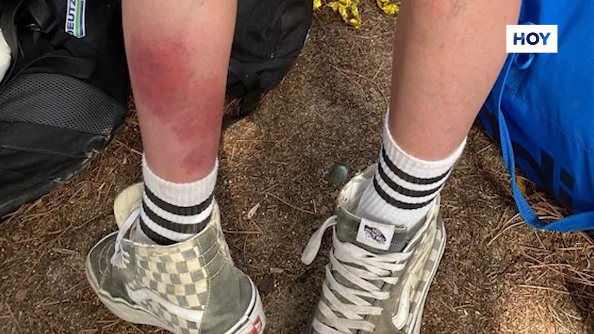 Cómo ir de festival y volver con 100 picaduras de pulgas