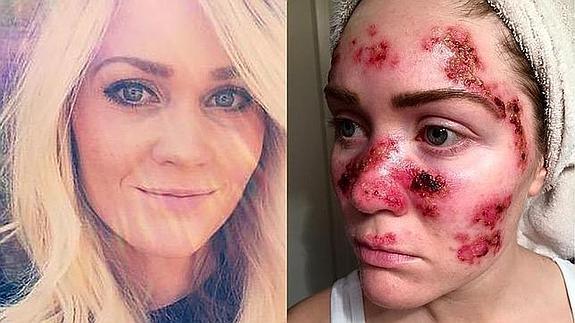 Difunde fotos de su cáncer de piel para alertar sobre las cabinas de bronceado