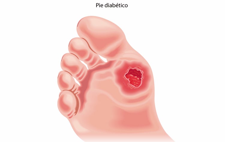ASOCULDIA impulsará la atención podológica en la cartera de servicios básicos del Sistema Nacional de Salud